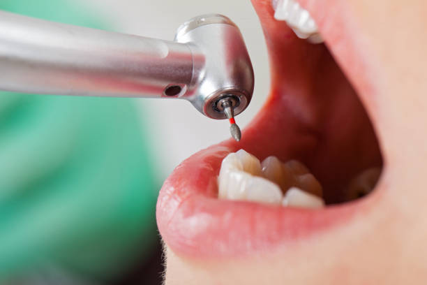 Best Emergency Dental Care for Broken or Chipped Teeth in Meade, KS